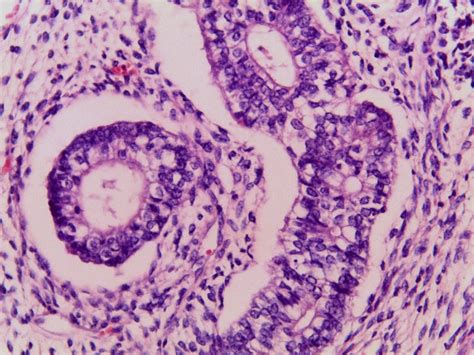 Yolk Sac Tumor Embryonal Glands Lined By Columnar Cells With Basal