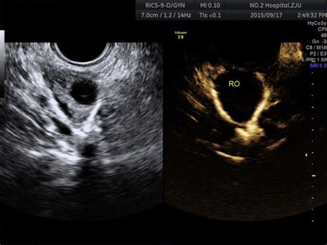 Hysterosalpingo Contrast Sonography With Four Dimensional Technique For Screening Fallopian