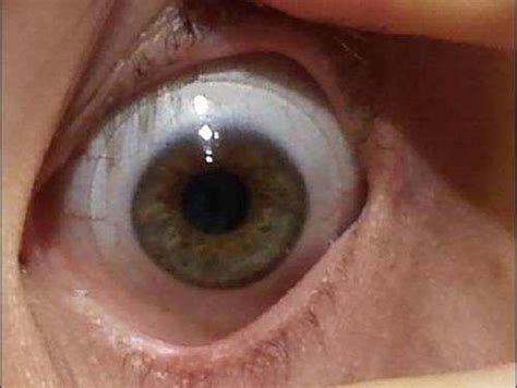 Scleral Contact Lenses What You Should Know