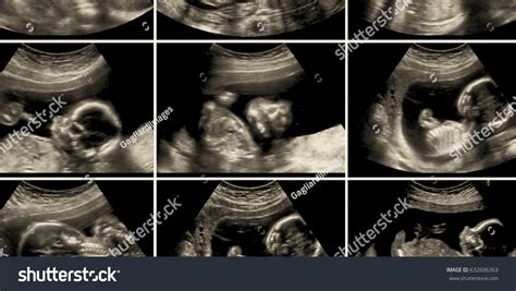 20 Week Fetus Images