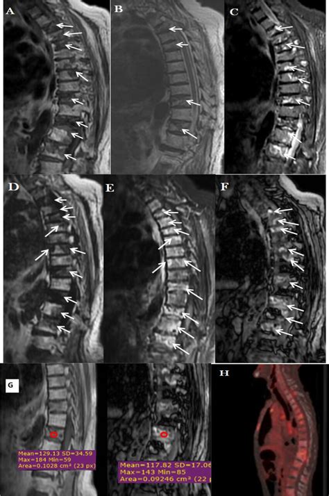 A H MRI And PET CT Images Of A 66 Year Old Male Patient With A History