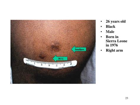 PPT - Recognition of BCG Scars PowerPoint Presentation - ID:3764793