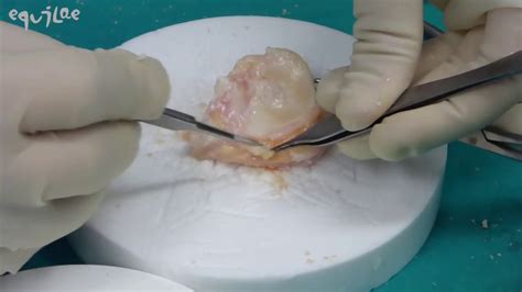 Fresh Osteochondral And Meniscus Allografting For Post Traumatic Tibial