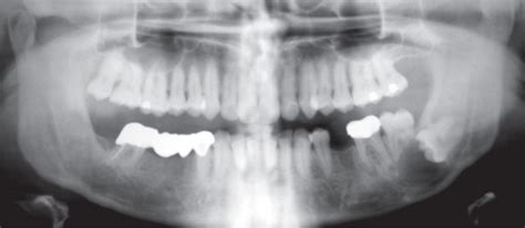 12 Cysts Of Orofacial Region Pocket Dentistry