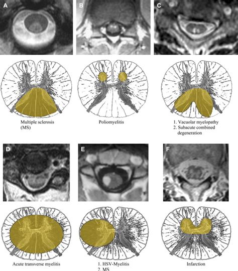 Demyelinating And Infectious Diseases Of The Spinal Cord Radiology Key