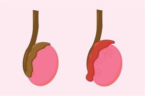 Ilustración De Epididimitis Inflamacion Epidídimo Epididimitis Es