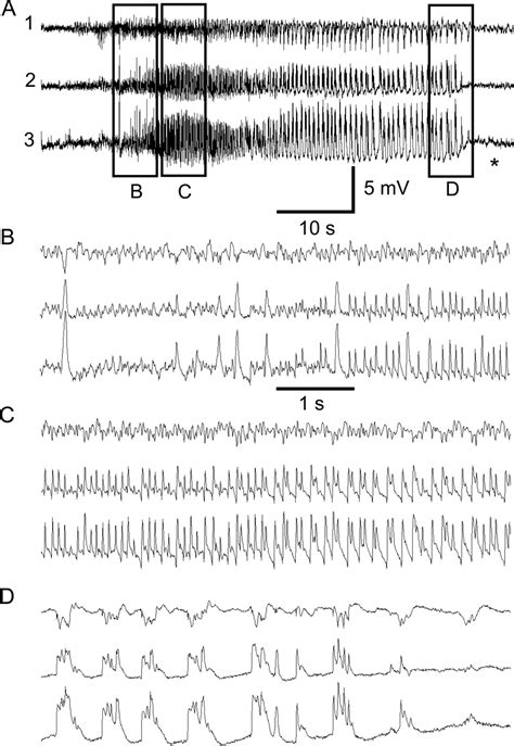 Development Of Spontaneous Recurrent Seizures After Kainate Induced