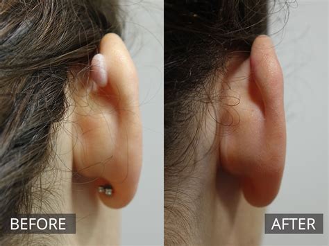 Keloid Scar Removal Treatment | The DOC Clinic Melbourne