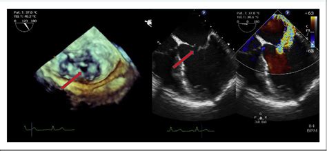 Figure 1 From Percutaneous Repair Of Mitral Valve Leaflet Perforation