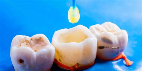 Choosing The Perfect Tooth Filling Material A Comprehensive Guide To