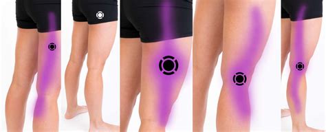 Lateral Knee Pain – Komizo Diagnostics