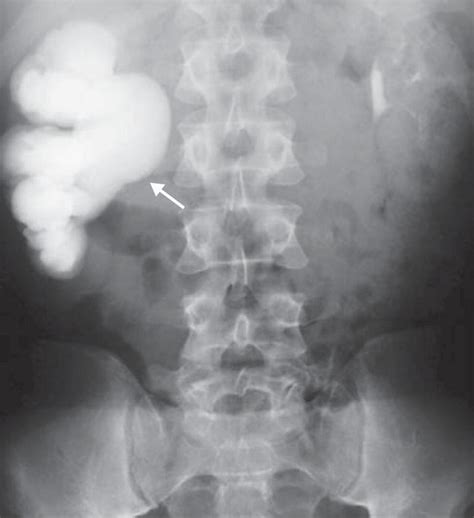 Retrograde Endopyelotomy | Abdominal Key