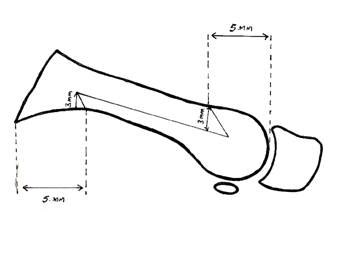 Full Text: Scarf osteotomy - Is it the procedure of choice in hallux valgus surgery? A ...