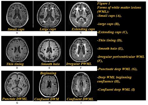 Classification Of White Matter Lesions