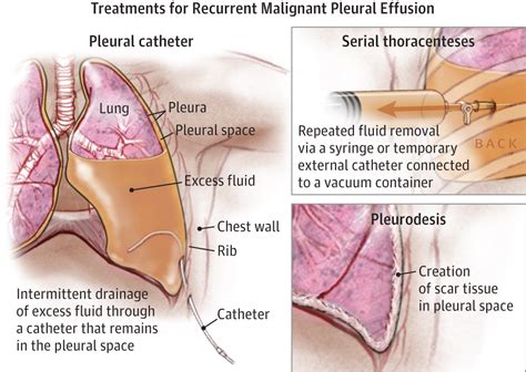 Malignant Pleural Effusions Breast Cancer Jama Oncology Jama Network