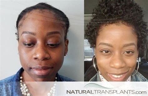 Traction Alopecia Tuesday Female Hair Transplant Before And After