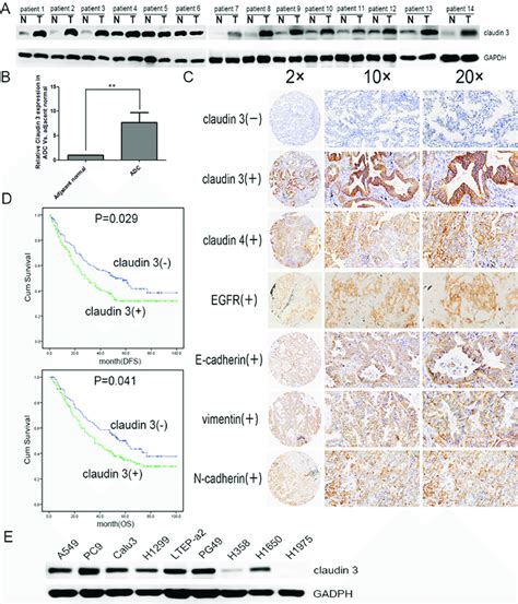 Cldn3 Expression In Lung Cancer Patients And Cell Lines A Cldn3