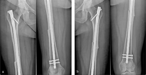 Radiographs of both femurs at 3 months after surgery. a Right femur b ...