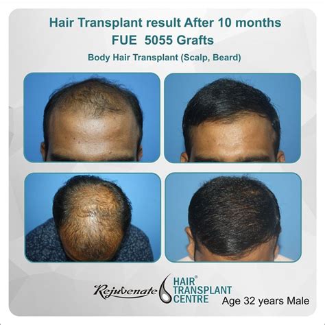 Fue Hair Transplant Result After Months Hair Transplant Results