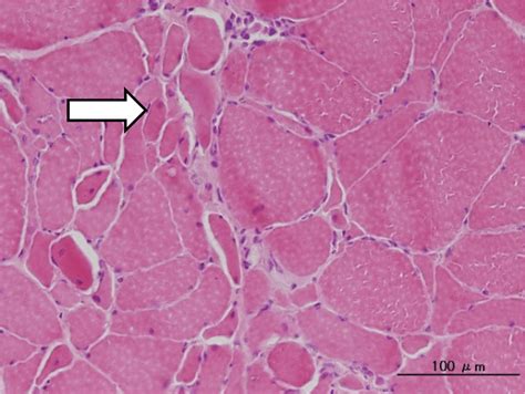 Muscle Atrophy Histology