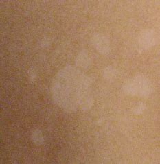 Light Colored Dry Spots On Skin - Infoupdate.org