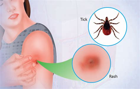 Health Condition : Symptoms, Causes, Treatment and More