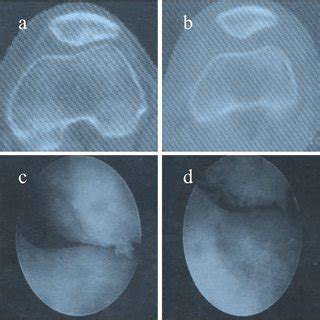 Pdf Outcome And Experience Of Arthroscopic Lateral Retinacular