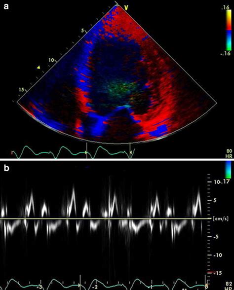 The Apical 4 Chamber View Overlaid With Tdi A And The Mitral Annular