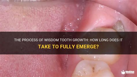 The Process Of Wisdom Tooth Growth How Long Does It Take To Fully