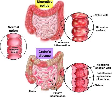 Inflammatory Bowel Disease Causes Signs Symptoms Diagnosis And Treatment