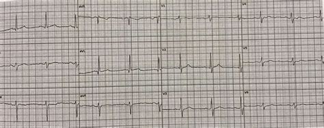 é Grave O Bloqueio Divisional Anterossuperior Esquerdo