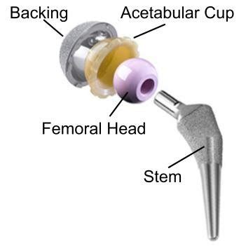 Artificial Hip Joint | Download Scientific Diagram