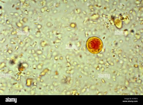 Entamoeba Histolytica Causes