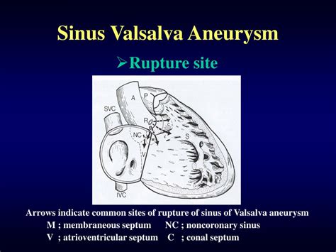 Ppt Sinus Valsalva Aneurysm Powerpoint Presentation Free Download