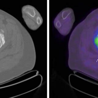 Computed tomography and fused positron emission tomography/computed ... 