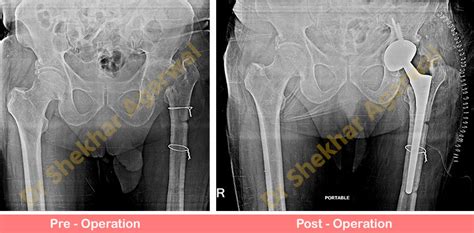 Revision Complex Total Hip Replacement Sant Parmanand Hospital