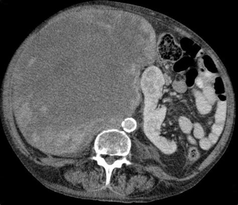 Liposarcoma Radiology Reference Article