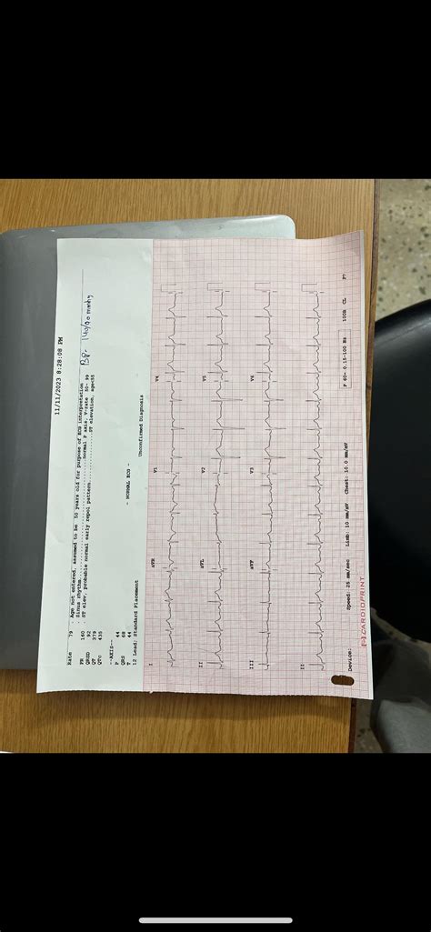 Is this an abnormal ECG? : r/ReadMyECG