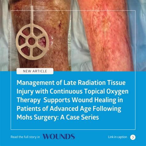 NATROX O₂ Managing Radiation Tissue Injury Post Mohs Surgery