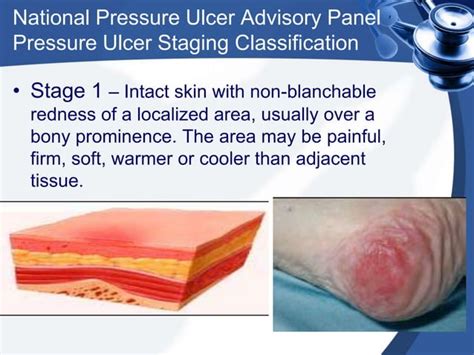 Pressure sores presentation