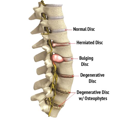 Degenerative Disc Disease Motus Physical Therapy