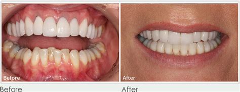 Clear Braces Essex | Invisible Braces | Perfect Smile Spa