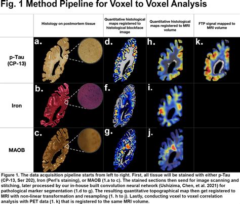 Deciphering the role of p‐tau, iron and MAOB in neurobiological basis ...