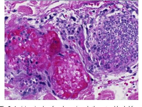 Figure 2 From Rapidly Progressive Necrotizing Cellulitis Secondary To Candida Tropicalis