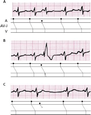 Ecg Patterns Of Supraventricular Arrhythmias Thoracic Key