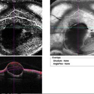 B Deep Angioplex Optical Coherence Tomography Angiography Octa