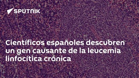 Científicos Españoles Descubren Un Gen Causante De La Leucemia