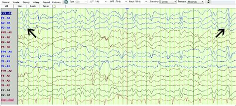 Postoperative Electroencephalogram Showing Triphasic Waves With