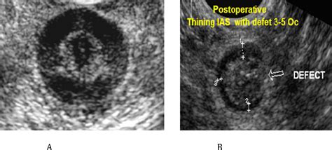 Figure From The Effect Of Lateral Sphincterotomy On The Anal