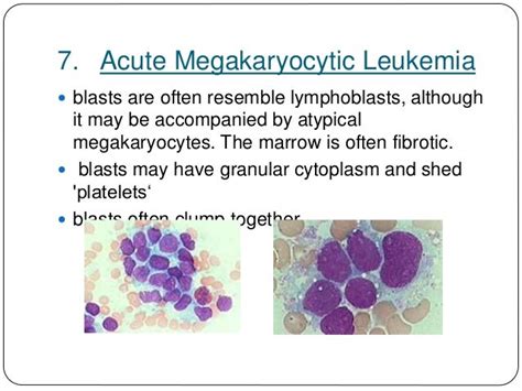 Leucaemias Lymphomas